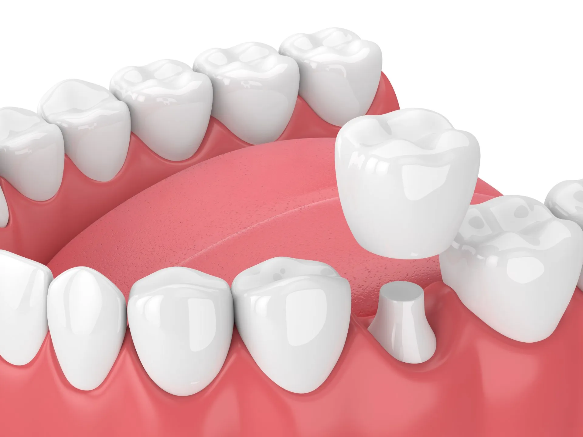 Everything You Need to Know About Crowns with Dr. Bindiya Bansal in New Delhi