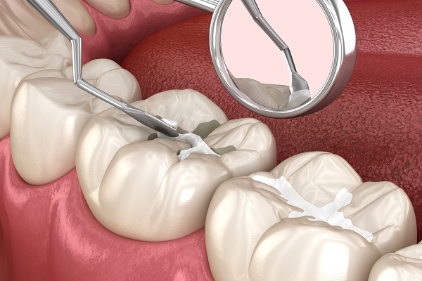 Dental Sealants Treatment by Specialist Dr. Bindiya Bansal in New Delhi
