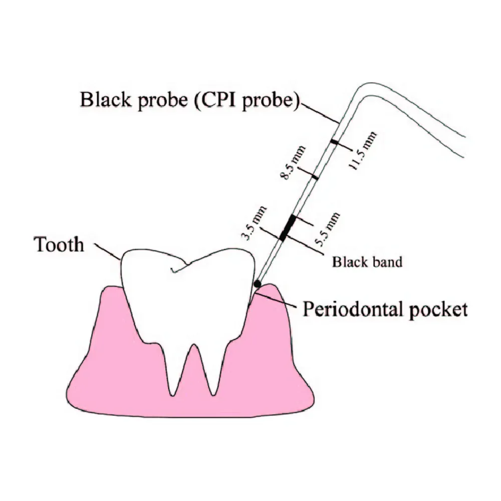 GDC Double End Probes Cp12 / Screening Probe #6 (Pcp12/11.5b) — Teethment catalog guide